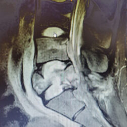Imagen de tomografía lateral de la columna cervical con visualización de un implante metálico en posición anterior. Las vértebras están bien alineadas, con alta definición ósea y contraste en tejidos blandos circundantes.