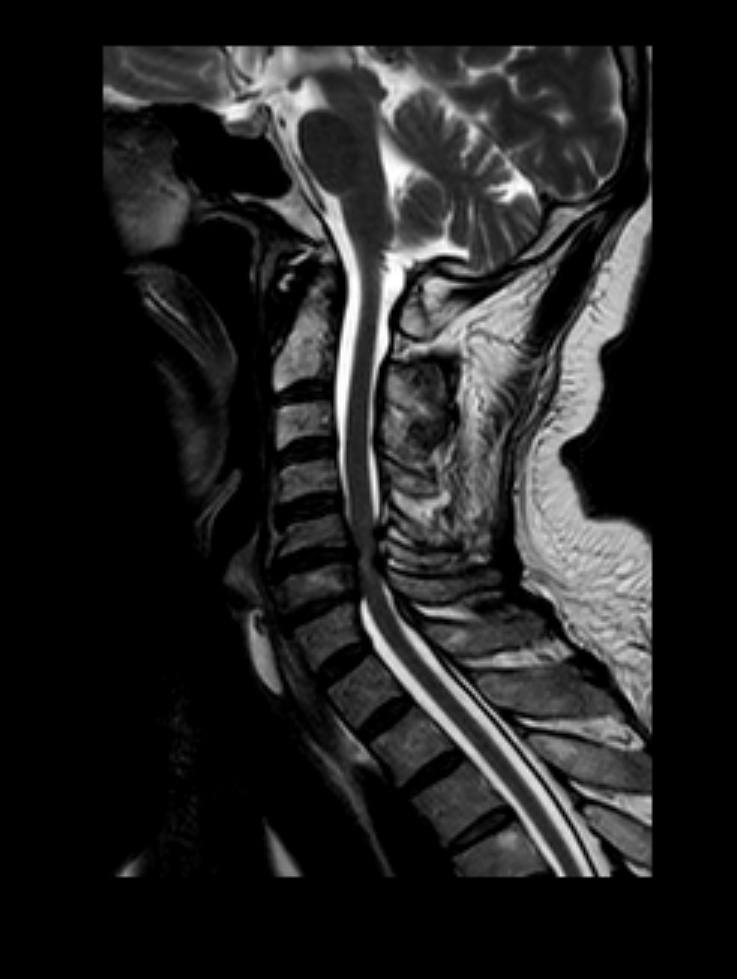Imagen de resonancia magnética de columna cervical en vista sagital que muestra canal medular sin estrechamiento ni compresión, utilizada como referencia anatómica normal.