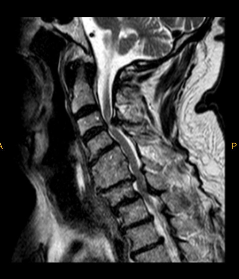 Resonancia magnética de columna cervical que muestra estenosis del canal medular, con compresión visible de la médula espinal en región cervical, compatible con canal estrecho.