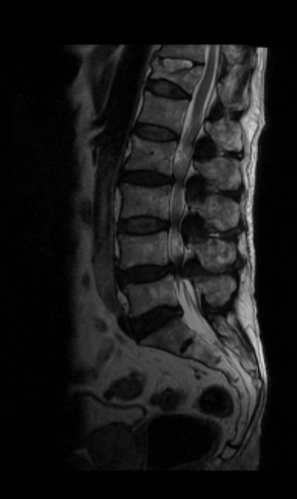 Imagen sagital de resonancia magnética que evidencia estenosis del canal lumbar, con disminución del espacio del canal raquídeo en varios niveles vertebrales.