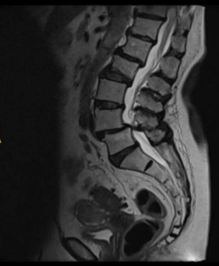 Resonancia magnética de columna lumbar que muestra estenosis de canal con reducción del espacio entre los discos intervertebrales y compresión del saco dural.