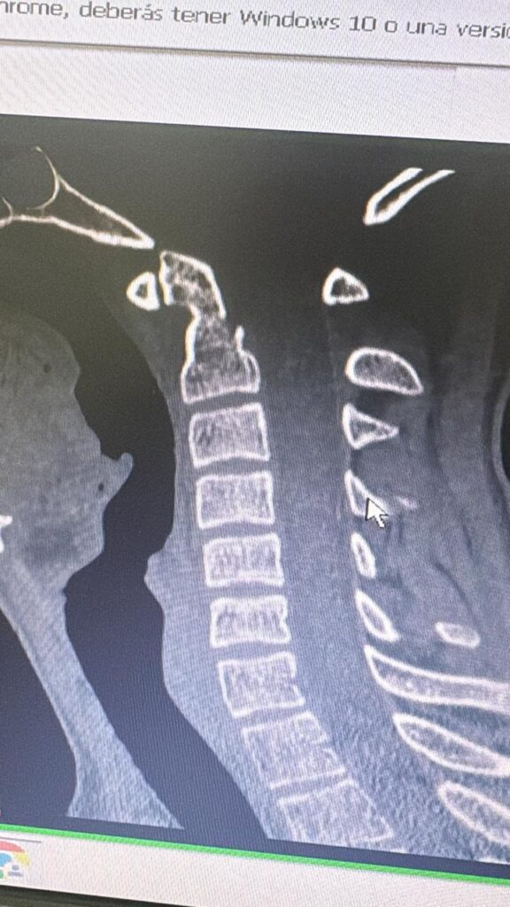 Tomografía lateral de columna cervical que muestra un implante metálico en la región anterior de las vértebras cervicales superiores. Se observa claramente el trazo de la columna vertebral y la estructura ósea con contraste marcado.