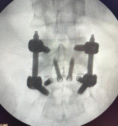 Radiografía frontal de columna lumbar con fijación anterior ALIF.