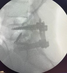 Radiografía lateral de columna lumbar con tornillos e implantes ALIF.