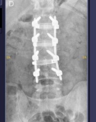 Radiografía frontal de columna lumbar con tornillos e implantes XLIF.