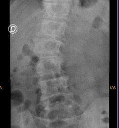 Radiografía frontal de columna lumbar sin implantes XLIF.
