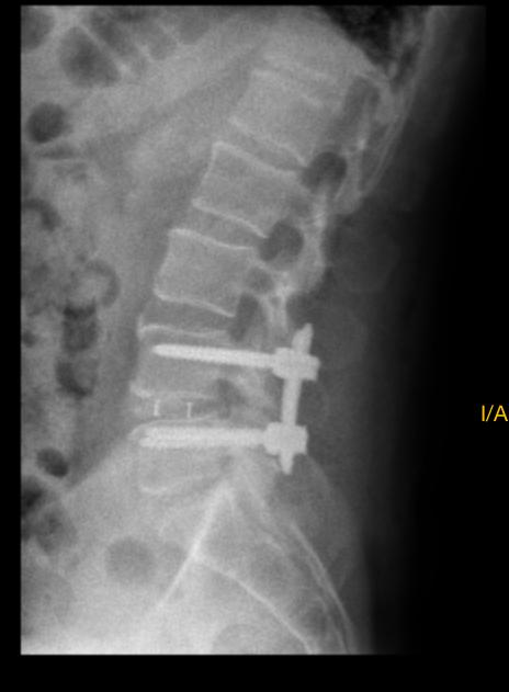 Radiografía lateral de columna lumbar con implantes tras cirugía MISTLIF